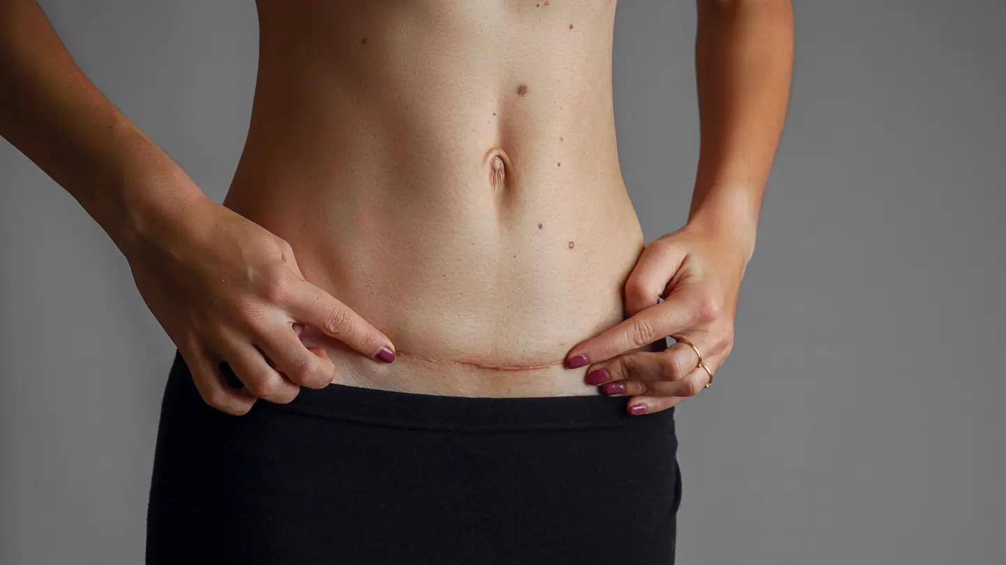 C-Sections: Benefits, Risks, and Recovery Tips